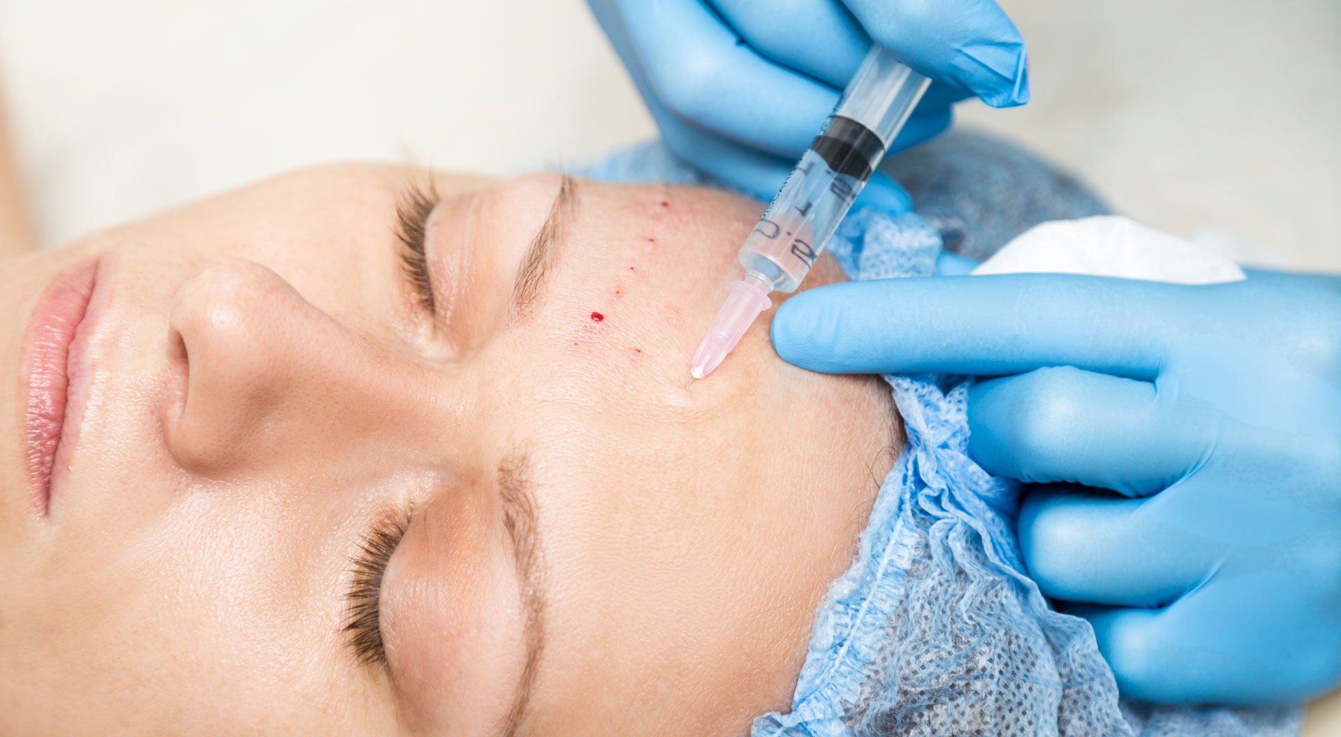 Mesotherapie | Wiesloch – Frauenweiler
